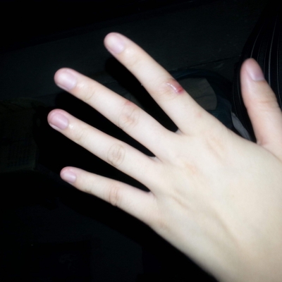 剖宮產(chǎn)術(shù)后宮頸妊娠概論[tag]