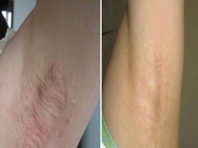 受傷后如何不留疤痕   疤痕常見(jiàn)有哪幾種分類(lèi)[tag]