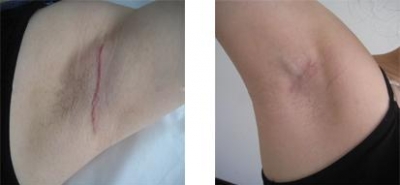 去疤痕的幾個方法 去疤痕食療妙招[tag]