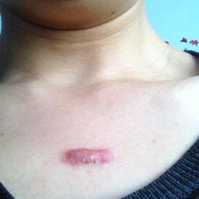 如何去疤痕 教你怎么除疤痕的方法[tag]