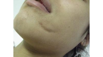 如何去疤痕 教你怎么除疤痕的方法[tag]