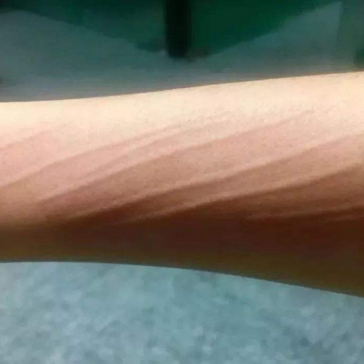 疤痕疙瘩修復(fù) 緩解疤痕疙瘩的方法[tag]