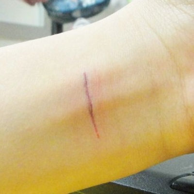 選擇適合你的去疤的方法 恢復(fù)完美肌膚[tag]