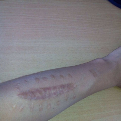 造成臉部疤痕的因素 嬰兒抓破臉會留疤嗎[tag]