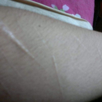 造成臉部疤痕的因素 嬰兒抓破臉會留疤嗎[tag]