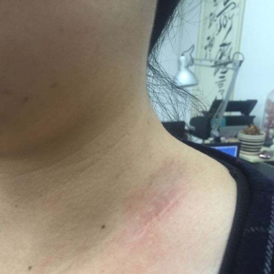 疤痕性體質(zhì)應(yīng)該怎么辦 疤痕體質(zhì)如何自我護(hù)理[tag]