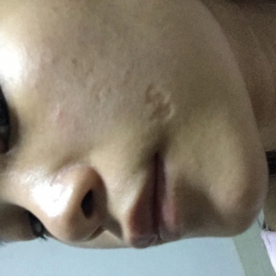 青春痘疤痕修復(fù)方法有哪些 如何處理青春痘疤痕[tag]