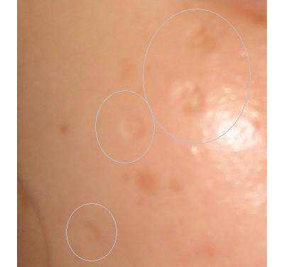 點(diǎn)陣激光對(duì)凸疤有用嗎 點(diǎn)陣激光的好處[tag]