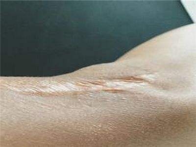 疤痕處植發(fā)的原理 手術過程是怎樣的[tag]