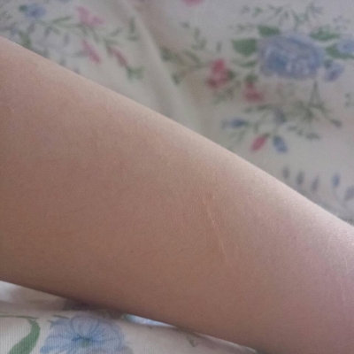 女生額頭痤瘡的治療秘方[tag]