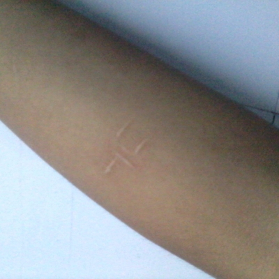 為你打造祛除額頭痤瘡的面膜，怎么做？[tag]