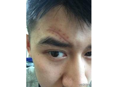 六招方法幫你去除抬頭紋[tag]