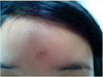 嬰兒胎記的顏色可分為哪幾種[tag]