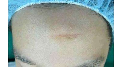 額頭疤痕有什么癥狀 可以整形美容嗎[tag]