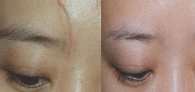 額頭疤痕怎么修復(fù) 額頭有疤痕的注意事項[tag]