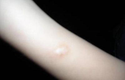 皮膚疤痕怎么辦 凹陷型疤痕修復(fù)方法有哪些[tag]