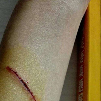 臉上的疤痕怎么修復 簡單介紹四種方式[tag]