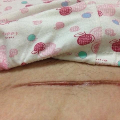 疤痕修復(fù)的價(jià)格一般是多少[tag]