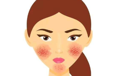 青春痘是怎么回事？為什么會長青春痘？[tag]