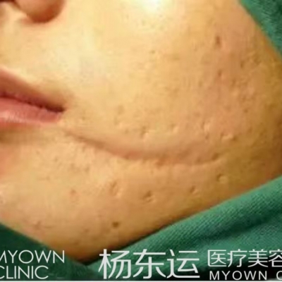 疤痕貼與減張貼配合使用，會(huì)不會(huì)影響減張效果？[tag]