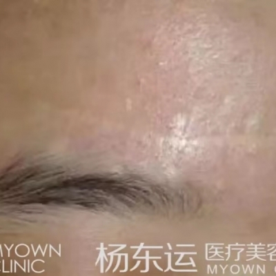 疤痕貼與減張貼配合使用，會(huì)不會(huì)影響減張效果？[tag]