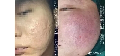 凹陷疤痕如何選擇切除還是剝離填充呢?[tag]