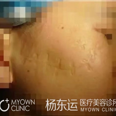 關(guān)于改良W改形術(shù)的優(yōu)勢介紹[tag]