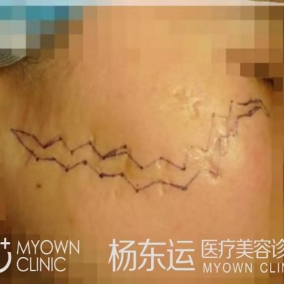 關(guān)于改良W改形術(shù)的優(yōu)勢介紹[tag]