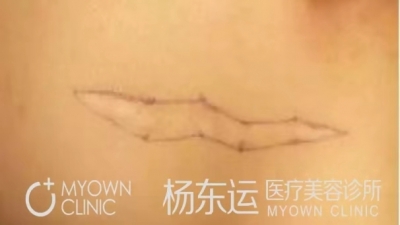 關(guān)于改良W改形術(shù)的優(yōu)勢介紹[tag]