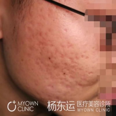 痘坑剝離填充術(shù)治療的具體情況分享[tag]