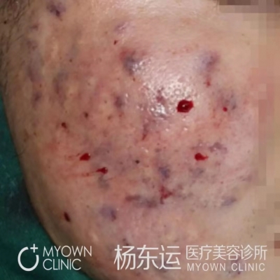 痘坑剝離填充術(shù)治療的具體情況分享[tag]