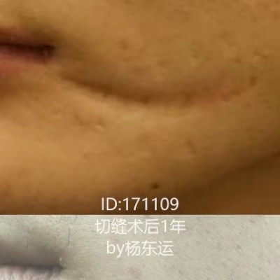 口周部位疤痕易動(dòng)不好護(hù)理，適合手術(shù)修復(fù)嗎？[tag]