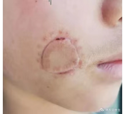 圓形或橢圓形疤痕手術(shù)切縫后如何進行減張?[tag]