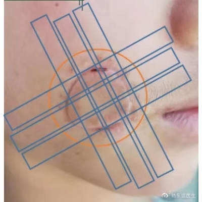 圓形或橢圓形疤痕手術(shù)切縫后如何進行減張?[tag]