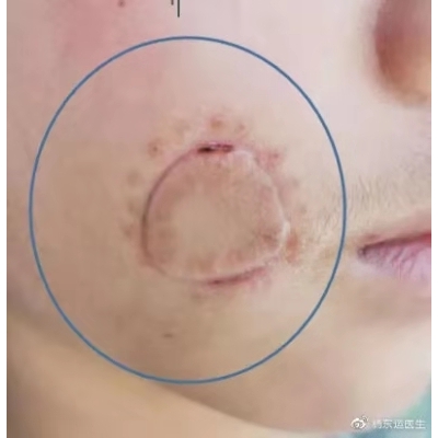 圓形或橢圓形疤痕手術(shù)切縫后如何進行減張?[tag]