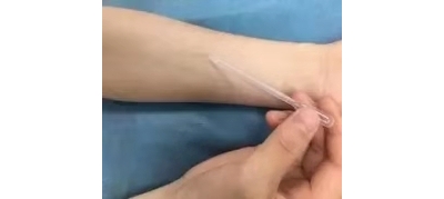 疤痕切縫術后用膠水粘傷口的優(yōu)缺點分析[tag]