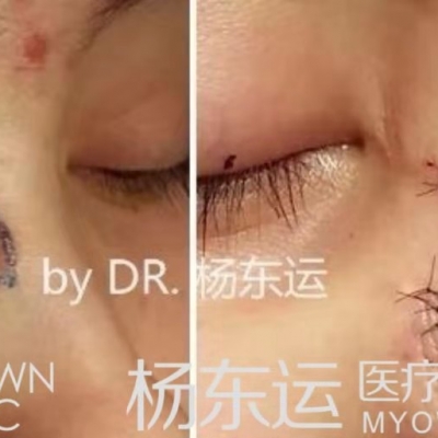 疤痕切縫術(shù)之改良菱形瓣的缺點(diǎn)分析[tag]