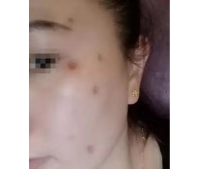 不要再使用藥物點(diǎn)痣了![tag]