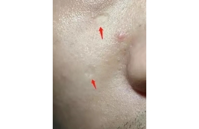 不要再使用藥物點(diǎn)痣了![tag]