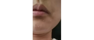 不要再使用藥物點(diǎn)痣了![tag]