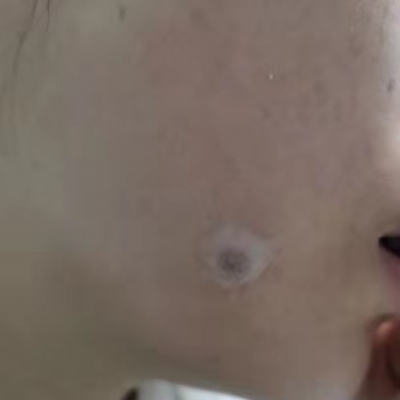 不要再使用藥物點(diǎn)痣了![tag]