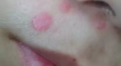 不要再使用藥物點(diǎn)痣了![tag]