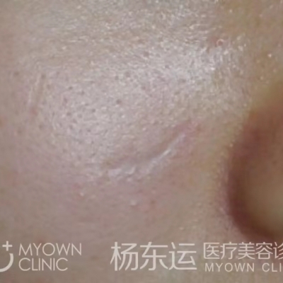 疤痕手術(shù)半年后就穩(wěn)定了嗎?[tag]