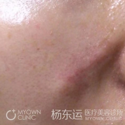 疤痕手術(shù)半年后就穩(wěn)定了嗎?[tag]