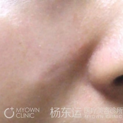 疤痕手術(shù)半年后就穩(wěn)定了嗎?[tag]