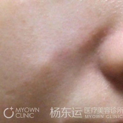 疤痕手術(shù)半年后就穩(wěn)定了嗎?[tag]