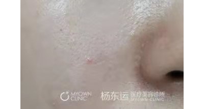 疤痕手術(shù)半年后就穩(wěn)定了嗎?[tag]