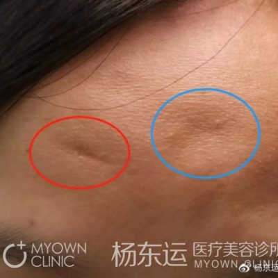 看似類似的凹陷疤痕，為何治療方法迥然不同？[tag]