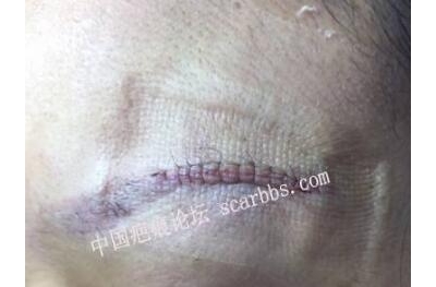 受傷后疤痕修復的時機必須要等半年后才可以嗎？[tag]