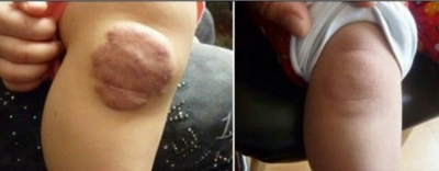 瘢痕疙瘩的幾種治療手段[tag]